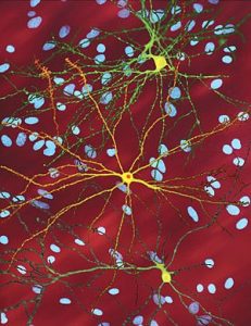 Huntington Disease neurons