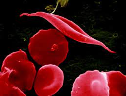 New gene therapy based treatment for sickle cell disease